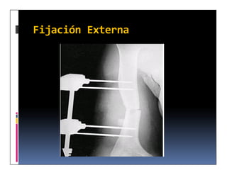 Fijación Externa
 