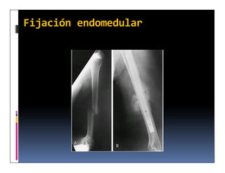 Fijación endomedular
 
