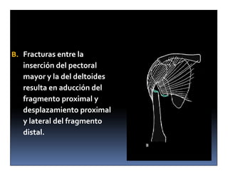 B. Fracturas entre la
   inserción del pectoral
   mayor y la del deltoides
   resulta en aducción del
   fragmento proximal y
   desplazamiento proximal
   y lateral del fragmento
   distal.
 