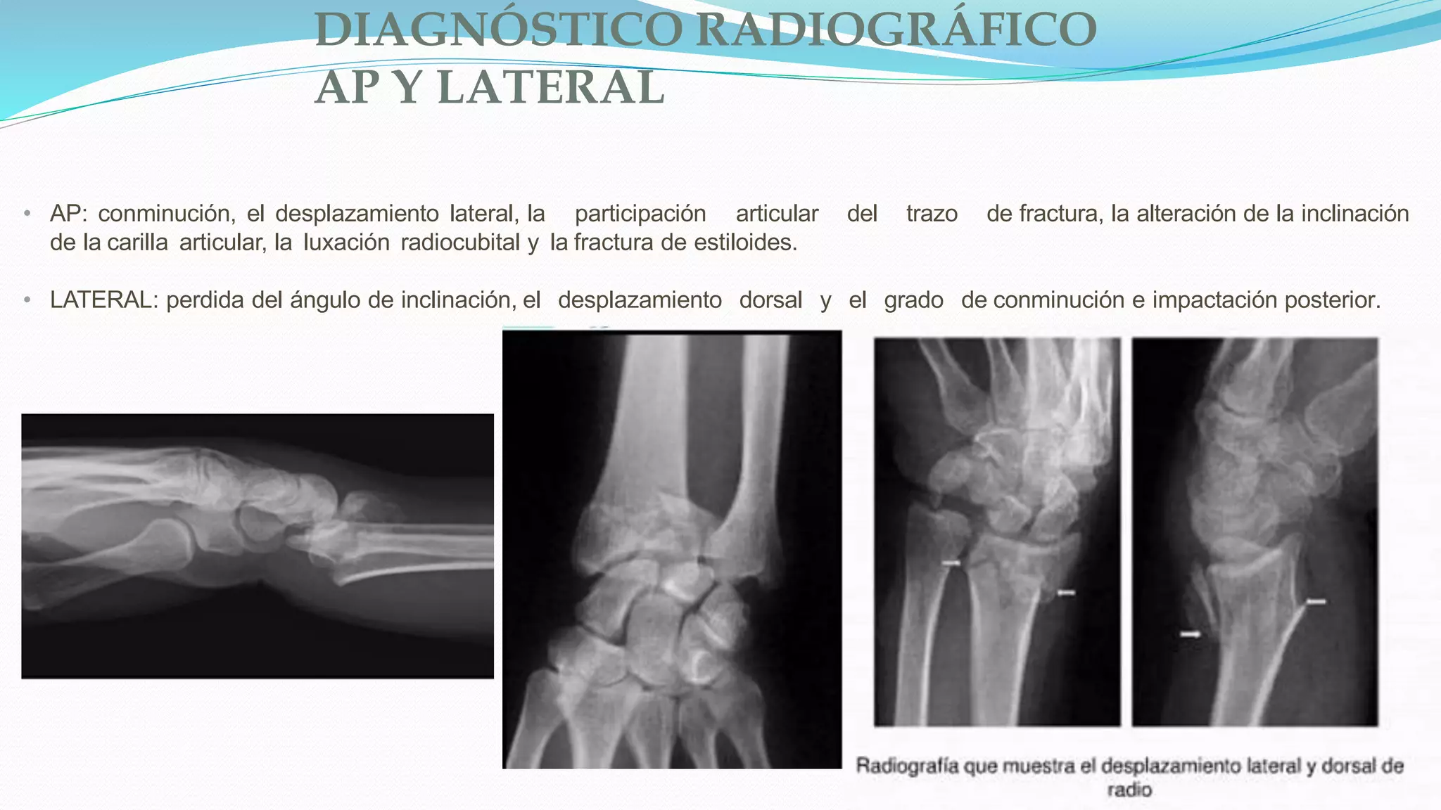 Fracturas distal del radio | PPTX