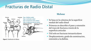 Fracturas de Radio Distal
Melone
 Se basa en la columna de la superficie
medial del radio distal
 Primeras en describir el paso y extensión
del trazo de fractura a través de la
superficie articular.
 Útil solo en fracturas intraarticulares
 Desplazamiento, grado de conminucion,
extensión a la diáfisis.
Tipo 1 Diáfisis radial
Tipo 2 Estiloides radial
Tipo 3 Fragmento volar cubital
Tipo 4 Fragmento dorsal cubital
 