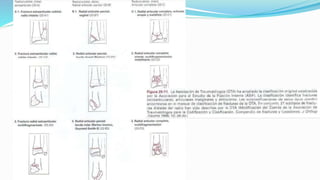 Fracturas distal del radio