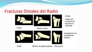 Fracturas Distales del Radio
 