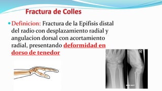 Definicion: Fractura de la Epifisis distal
del radio con desplazamiento radial y
angulacion dorsal con acortamiento
radial, presentando deformidad en
dorso de tenedor
 