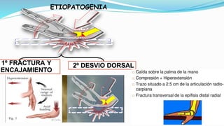 1º FRACTURA Y
ENCAJAMIENTO
2º DESVIO DORSAL
ETIOPATOGENIA
 