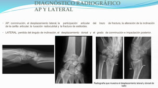 DIAGNÓSTICO RADIOGRÁFICO
AP Y LATERAL
• AP: conminución, el desplazamiento lateral, la participación articular del trazo de fractura, la alteración de la inclinación
de la carilla articular, la luxación radiocubital y la fractura de estiloides.
• LATERAL: perdida del ángulo de inclinación, el desplazamiento dorsal y el grado de conminución e impactación posterior.
 