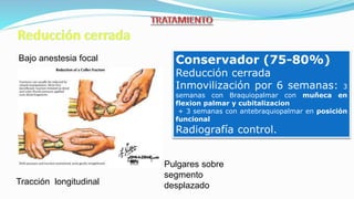 Bajo anestesia focal
Pulgares sobre
segmento
desplazadoTracción longitudinal
Conservador (75-80%)
Reducción cerrada
Inmovilización por 6 semanas: 3
semanas con Braquiopalmar con muñeca en
flexion palmar y cubitalizacion
+ 3 semanas con antebraquiopalmar en posición
funcional
Radiografía control.
 