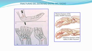 FRACTURAS DEL EXTREMO DISTAL DEL RADIO
 