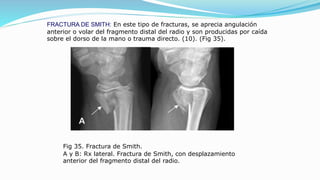 FRACTURA DE SMITH: En este tipo de fracturas, se aprecia angulación
anterior o volar del fragmento distal del radio y son producidas por caída
sobre el dorso de la mano o trauma directo. (10). (Fig 35).
Fig 35. Fractura de Smith.
A y B: Rx lateral. Fractura de Smith, con desplazamiento
anterior del fragmento distal del radio.
 