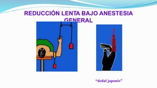 REDUCCIÓN LENTA BAJO ANESTESIA
GENERAL
“dedal japonés”
 
