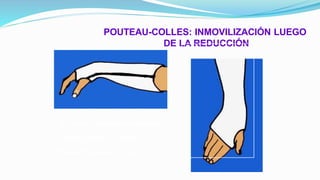 POUTEAU-COLLES: INMOVILIZACIÓN LUEGO
DE LA REDUCCIÓN
• Flexión + inclinación cubital
• Radiografías de control
• Inmovilización 6 semanas
 