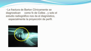• La fractura de Barton Clínicamente se
diagnostican como fx de Colles , y solo el
estudio radiográfico nos da el diagnóstico,
especialmente la proyección de perfil.
 