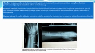 Alambres percutáneos:En las fracturas que no tengan severa conminución o estén osteoporóticas se emplean alambres
percutáneos. se pasan perpendiculares al foco de fractura.1-3,14
Fijadores externos: solamente o con otros medios de osteosíntesis se realiza en las fracturas colapsadas, conminutivas, que son
muy inestables, cuando sea necesario en los pacientes casos en que exista un defecto óseo importante se aplicará injerto óseo ó
hidroxiapatita.
Fijación interna: Se realiza la fijación interna con más frecuencia en las fracturas tipo , en las que se utilizan láminas o tornillos AO.
 