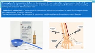 Artroscopia: en las fracturas intraarticulares con desplazamiento de 1 mm o más, se fijan los fragmentos con alambres K de 0,5
mm, se mantiene la reducción lograda con un aparato de fijación externa y se rellena el área de defecto óseo con injerto autólogo o
hidroxiapatita para cubrir el área de defecto óseo.
Cemento óseo remodelable: la ténica de inyectar cemento óseo remodelable (Norian SRS) en el foco de fractura previamente
reducida y mantenier un yeso por 2 semanas.
Presenta como complicación el atrapamiento de los tendones cuando quedaba resto del producto en partes blandas.13
 