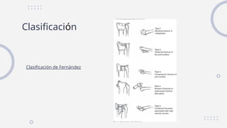 Comprehensive Overview of Distal Radius Fractures: Diagnosis ...