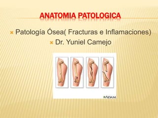 ANATOMIA PATOLOGICA
 Patología Ósea( Fracturas e Inflamaciones)
 Dr. Yuniel Camejo
 