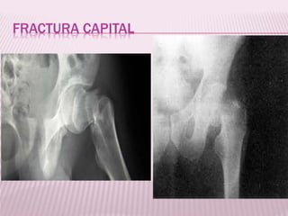 FRACTURA CAPITAL 
 