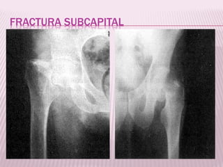 FRACTURA SUBCAPITAL 
 