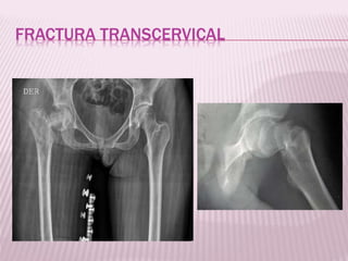 FRACTURA TRANSCERVICAL 
 