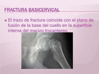 FRACTURA BASICERVICAL 
 El trazo de fractura coincide con el plano de 
fusión de la base del cuello en la superficie 
interna del macizo trocantereo. 
 