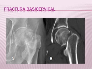 FRACTURA BASICERVICAL 
 