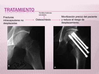 TRATAMIENTO 
Fracturas 
intracapsulares no 
desplazadas 
Osteosíntesis 
Movilización precoz del paciente 
y reduce el riesgo de 
desplazamiento. 
Tornillos tirafondo 
canulados 
 