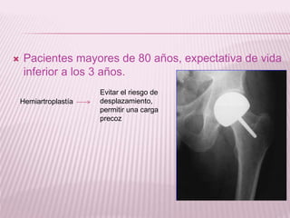 Pacientes mayores de 80 años, expectativa de vida 
inferior a los 3 años. 
Hemiartroplastía 
Evitar el riesgo de 
desplazamiento, 
permitir una carga 
precoz 
 