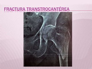 FRACTURA TRANSTROCANTÉREA 
 