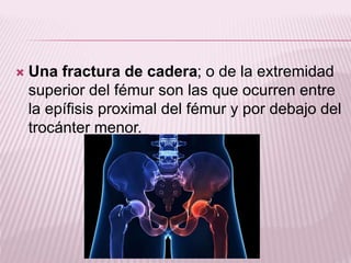  Una fractura de cadera; o de la extremidad 
superior del fémur son las que ocurren entre 
la epífisis proximal del fémur y por debajo del 
trocánter menor. 
 