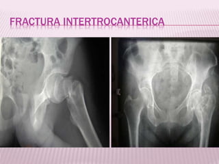 FRACTURA INTERTROCANTERICA 
 