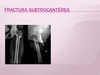 FRACTURA SUBTROCANTÉREA 
 