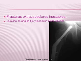  Fracturas extracapsulares inestables: 
 La placa de ángulo fijo y la lámina placa aportan 
Tornillo deslizable y placa 
 