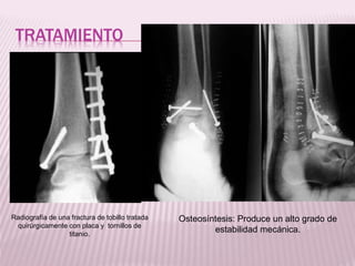 TRATAMIENTO 
Radiografía de una fractura de tobillo tratada 
quirúrgicamente con placa y tornillos de 
titanio. 
Osteosíntesis: Produce un alto grado de 
estabilidad mecánica. 
 
