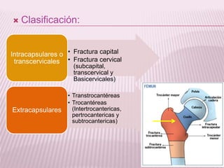  Clasificación: 
• Fractura capital 
• Fractura cervical 
(subcapital, 
transcervical y 
Basicervicales) 
Intracapsulares o 
transcervicales 
• Transtrocantéreas 
• Trocantéreas 
(Intertrocantericas, 
pertrocantericas y 
subtrocantericas) 
Extracapsulares 
 