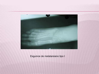 Esguince de metatarsiano tipo I 
 