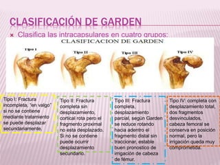 CLASIFICACIÓN DE GARDEN 
 Clasifica las intracapsulares en cuatro grupos: 
Tipo I: Fractura 
incompleta, “en valgo” 
si no se contiene 
mediante tratamiento 
se puede desplazar 
secundariamente. 
Tipo II: Fractura 
completa sin 
desplazamiento, 
cortical rota pero el 
fragmento proximal 
no esta desplazado. 
Si no se contiene 
puede ocurrir 
desplazamiento 
secundario. 
Tipo III: Fractura 
completa, 
desplazamiento 
parcial, según Garden 
se reduce rotando 
hacia adentro el 
fragmento distal sin 
traccionar, estable 
buen pronostico de 
irrigación de cabeza 
de fémur. 
Tipo IV: completa con 
desplazamiento total, 
dos fragmentos 
desvinculados, 
cabeza femoral se 
conserva en posición 
normal, pero la 
irrigación queda muy 
comprometida. 
 