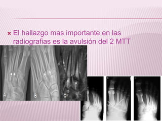  El hallazgo mas importante en las 
radiografias es la avulsión del 2 MTT 
 