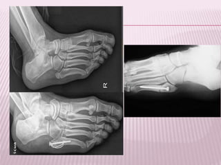 Fracturas en adultos