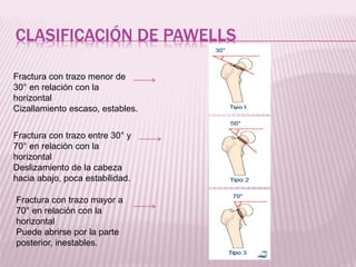 CLASIFICACIÓN DE PAWELLS 
Fractura con trazo menor de 
30° en relación con la 
horizontal 
Cizallamiento escaso, estables. 
Fractura con trazo entre 30° y 
70° en relación con la 
horizontal 
Deslizamiento de la cabeza 
hacia abajo, poca estabilidad. 
Fractura con trazo mayor a 
70° en relación con la 
horizontal 
Puede abrirse por la parte 
posterior, inestables. 
 
