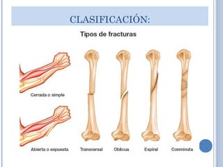 CLASIFICACIÓN:
 