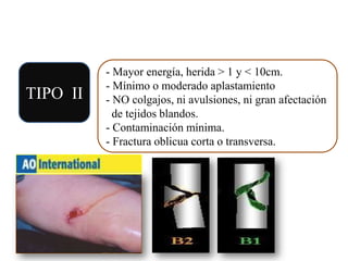 TIPO II
- Mayor energía, herida > 1 y < 10cm.
- Mínimo o moderado aplastamiento
- NO colgajos, ni avulsiones, ni gran afectación
de tejidos blandos.
- Contaminación mínima.
- Fractura oblicua corta o transversa.
 