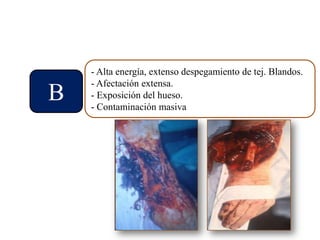 B
- Alta energía, extenso despegamiento de tej. Blandos.
- Afectación extensa.
- Exposición del hueso.
- Contaminación masiva
 