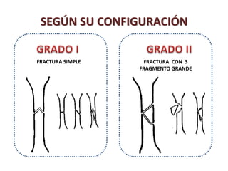 SEGÚN SU CONFIGURACIÓN
FRACTURA SIMPLE FRACTURA CON 3
FRAGMENTO GRANDE
 