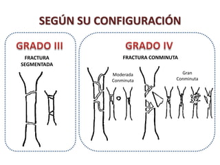 FRACTURA
SEGMENTADA
FRACTURA CONMINUTA
SEGÚN SU CONFIGURACIÓN
Moderada
Conminuta
Gran
Conminuta
 