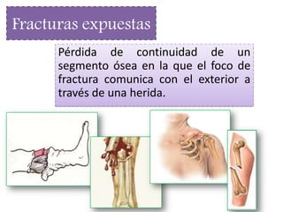 Pérdida de continuidad de un
segmento ósea en la que el foco de
fractura comunica con el exterior a
través de una herida.
Fracturas expuestas
 