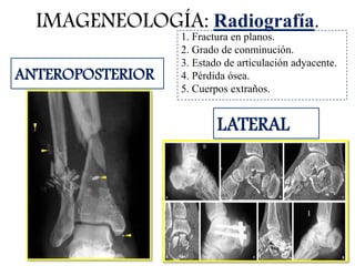 IMAGENEOLOGÍA: Radiografía.
1. Fractura en planos.
2. Grado de conminución.
3. Estado de articulación adyacente.
4. Pérdida ósea.
5. Cuerpos extraños.
ANTEROPOSTERIOR
LATERAL
 