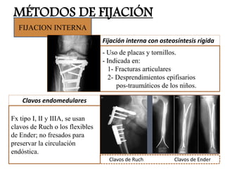 MÉTODOS DE FIJACIÓN
FIJACION INTERNA
- Uso de placas y tornillos.
- Indicada en:
1- Fracturas articulares
2- Desprendimientos epifisarios
pos-traumáticos de los niños.
Fx tipo I, II y IIIA, se usan
clavos de Ruch o los flexibles
de Ender; no fresados para
preservar la circulación
endóstica.
Fijación interna con osteosíntesis rígida
Clavos endomedulares
Clavos de Ruch Clavos de Ender
 