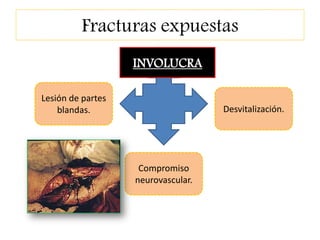 Fracturas expuestas
INVOLUCRA
Lesión de partes
blandas.
Compromiso
neurovascular.
Desvitalización.
 