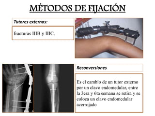 MÉTODOS DE FIJACIÓN
Tutores externos:
Reconversiones
fracturas IIIB y IIIC.
Es el cambio de un tutor externo
por un clavo endomedular, entre
la 3era y 6ta semana se retira y se
coloca un clavo endomedular
acerrojado
 