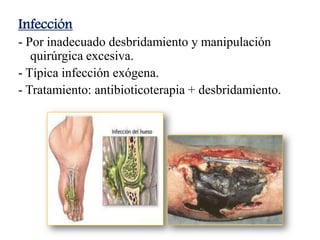 Infección
- Por inadecuado desbridamiento y manipulación
quirúrgica excesiva.
- Típica infección exógena.
- Tratamiento: antibioticoterapia + desbridamiento.
 